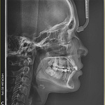 ТРГ Телерентгенография черепа в одной проекции